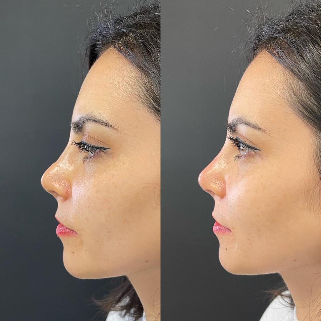 Dr. Ersin Aydın - Before&After - Rhinoplasty with Filler