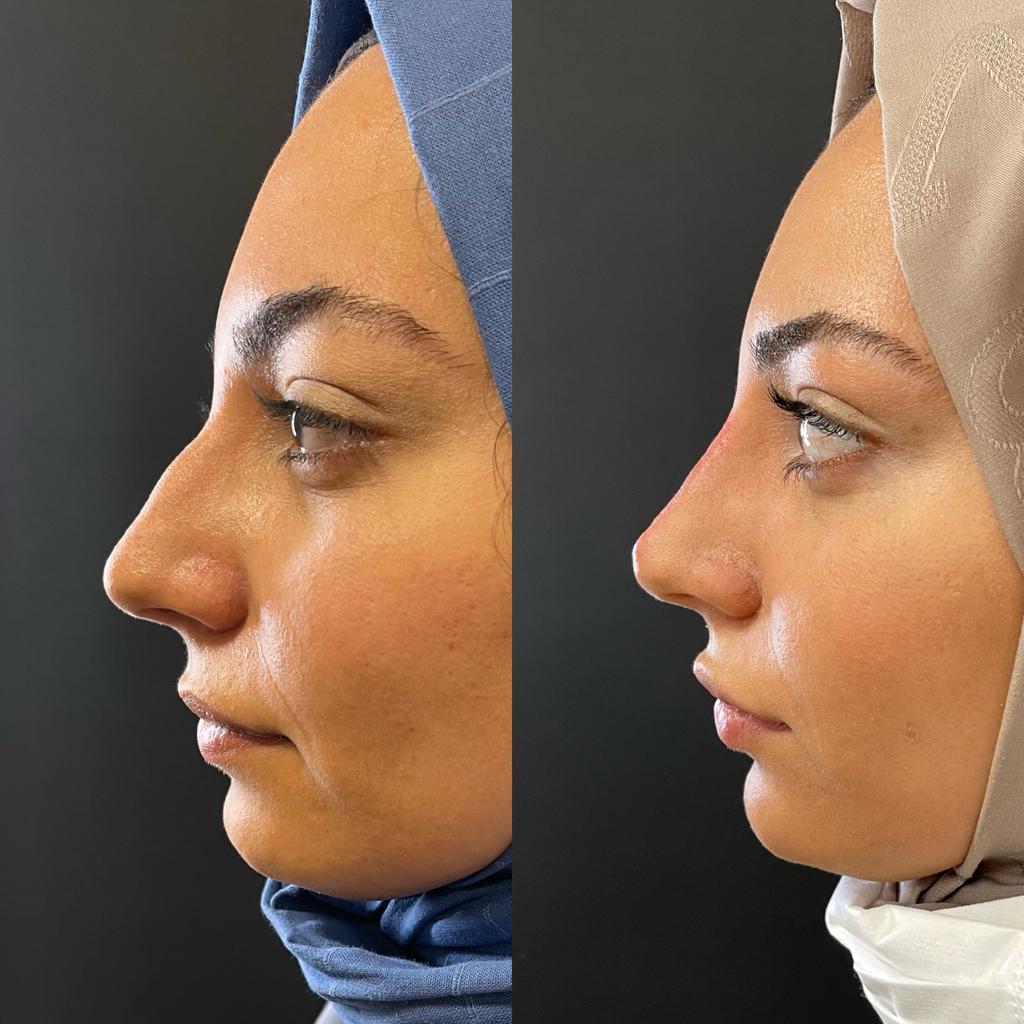 Dr. Ersin Aydın - Before&After - Rhinoplasty with Filler