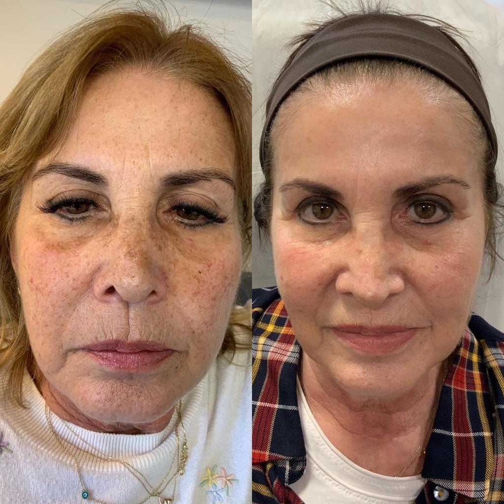 Dr. Ersin Aydın - Before&After - Laser Treatment